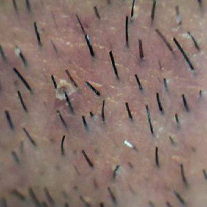 Peli nel corpo umano. Irsutismo, ipertricosi, alopecia